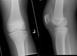 <p>break at the growth plate; epiphysis separates from diaphysis</p>