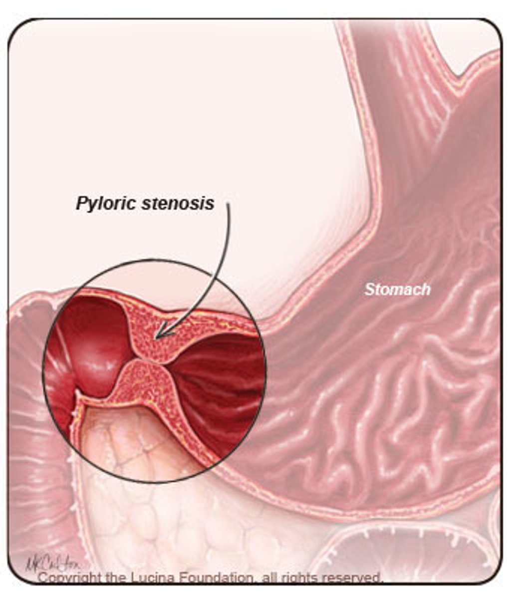 <p>Blocking or narrowing of the opening between the stomach and duodenum, which can be acquired or congenital.</p><p>- Epigastric pain and fullness, nausea, succussion splash, vomiting; prolonged cases can lead to malnutrition and dehydration.</p><p>- Gastric drainage; intravenous (IV) fluid and electrolytes; IV nutrition; proton pump inhibitors or H2 receptor antagonists; surgery or stenting.</p>