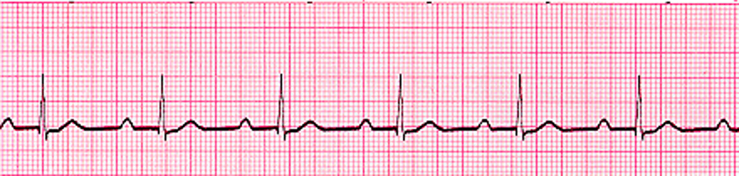 <p>The AV node holds each sinus impulse longer than normal before allowing the conduction through the ventricles</p><p>PR interval = prolonged (&gt; 0.20 seconds), but consistent</p>