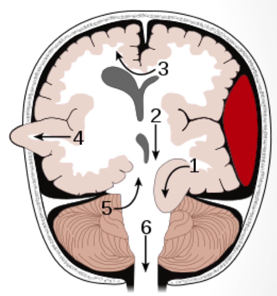 <p>brain matter squeezes through a fracture or opening in the skull. This only occurs in the case of open injuries or craniotomy (4)</p>