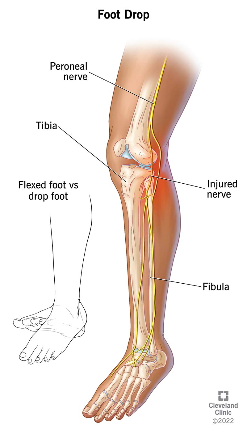 <p>damage to the common fibular nerve </p><ul><li><p>damage to the lateral and anterior compartments of the leg/foot</p><ul><li><p>unable to dorsiflex the foot</p></li><li><p>unable to extend the toes</p></li><li><p>unable to evert the foot</p></li><li><p>anasthesia in the dorsum of the foot</p></li></ul></li></ul><p></p>