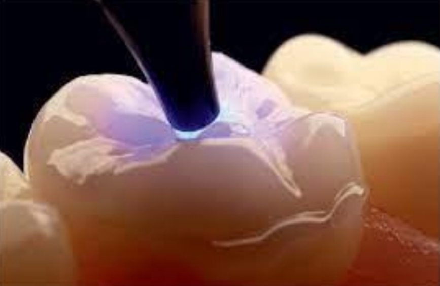 <p>Fill tooth and restoration with dual cement</p><p>Place tooth with pressure occlusally</p><p>Polymerise for 5 secs then remove excess cement</p><p class="has-focus">Cure each surface for 1 minute</p>