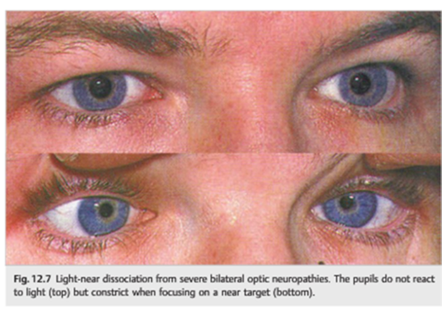 <p>pupil that does NOT respond to light, but does have a near response</p>