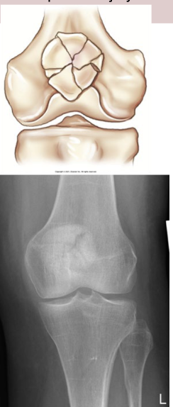 <p>Fracture radiates in a star like pattern from central point of injury</p>