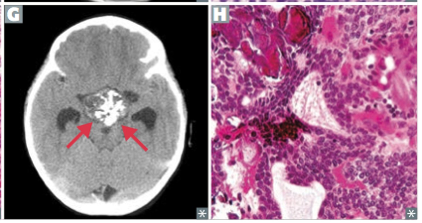 <p>rare extra-axial epithelial tumor the sellar region</p>