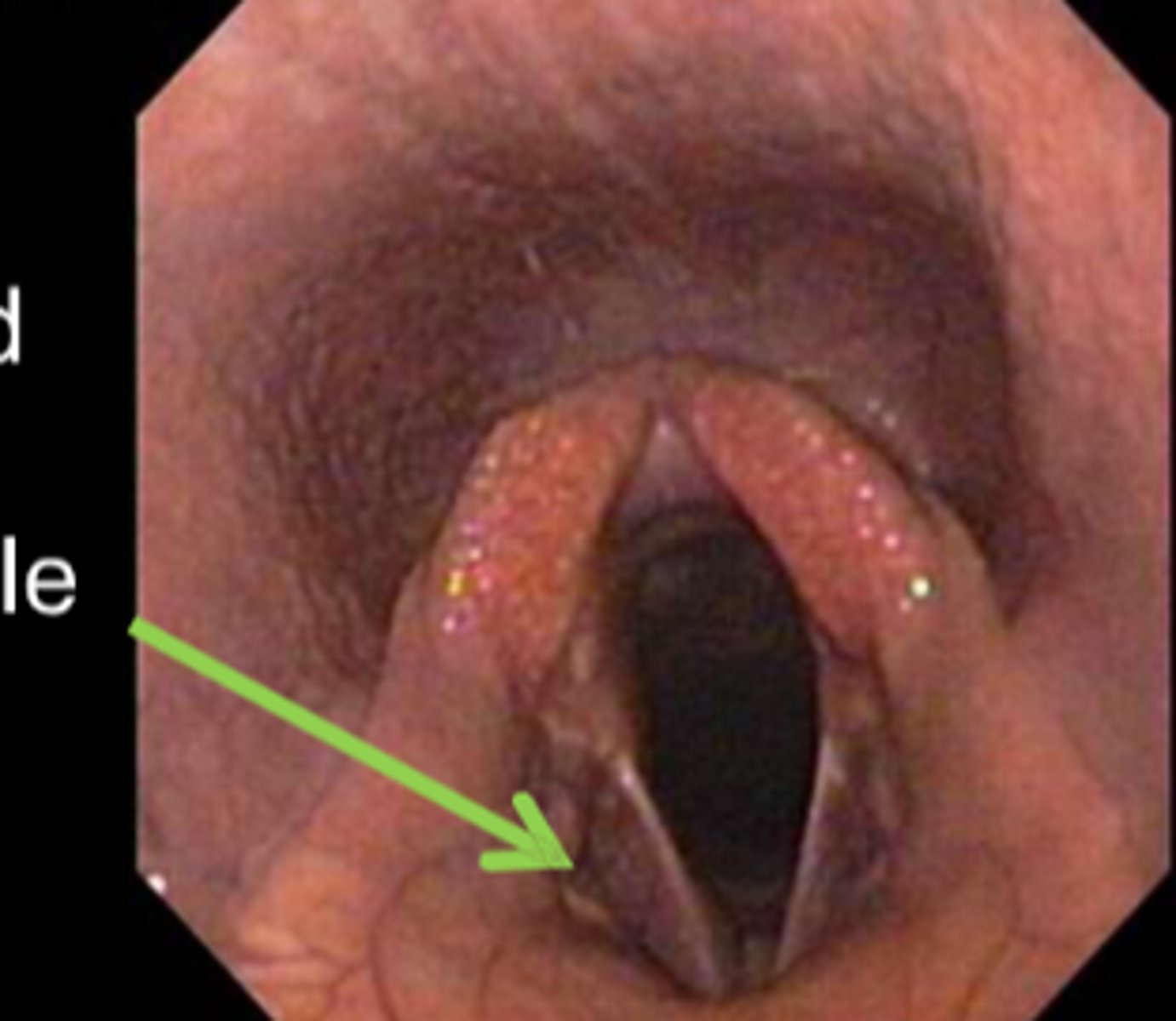 <p>the anterior extension of the laryngeal ventricle; a pouch that secretes lubricating mucus into the laryngeal cavity</p>