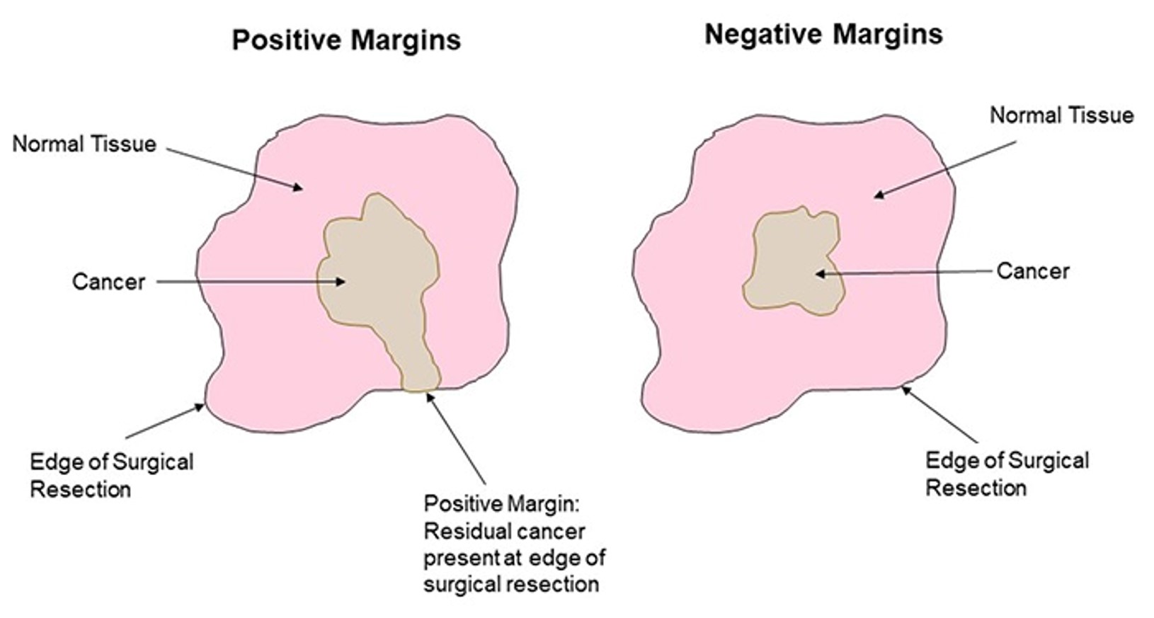 <ul><li><p>The accurate definition of surgical resection margins is an critical prognostic factor in cancer surgery</p></li><li><p>40% of cancers treated following removal of “tumour margin with clearances” </p></li><li><p>Positive and Negative margins have consequences</p><ul><li><p>+ve = residual cancer on edge of surgical resection</p></li><li><p>-ve = cancer contained inside surgical resection</p></li></ul></li><li><p>Margins currently defined by sight and feel </p></li><li><p>Unmet clinical need</p></li></ul><p></p>