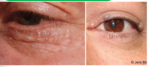 <ol><li><p>Clear, cystic, translucent lesion</p><ol><li><p>• <u>Sometimes </u>appear bluish</p></li></ol></li><li><p>• Can occur <strong><u>near but not at eyelid margin and around cheeks</u></strong></p></li><li><p>• More likely to be <strong><u>multiple lesions</u></strong></p></li></ol><p></p>