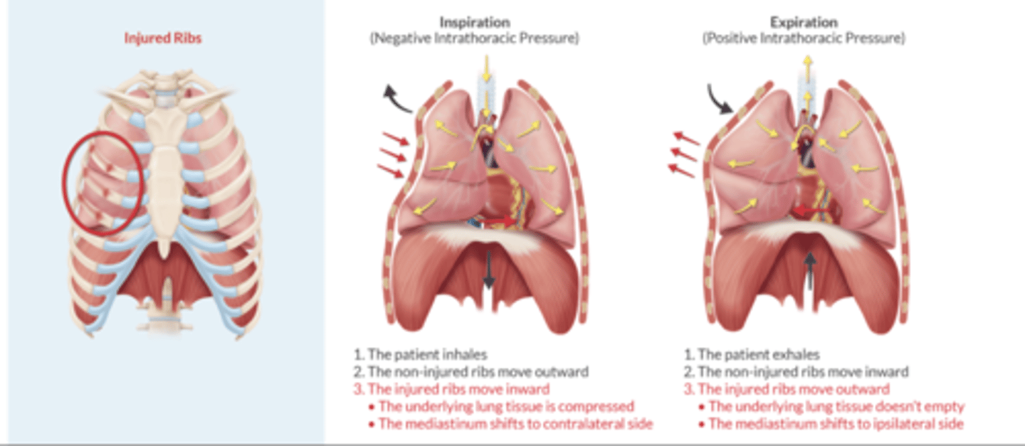 <p>Consequence of blunt chest trauma with multiple rib Fx. </p><p>Key characteristic: paradoxical movement of chest wall at the site of the fractures</p><p>Inspiration (Negative Intrathoracic pressure)</p><p>injured ribs move inward &amp; collapse the affected region, mediastinum shifts to contralateral side</p><p>Expiration (Positive Intrathoracic Pressure) </p><p>injured ribs move outward &amp; affected region doesn't empty, mediastinum shifts to ipsilateral side</p><p>Treatment = epidural catheter or intercostal nerve blocks (higher risk of LA toxicity)</p>