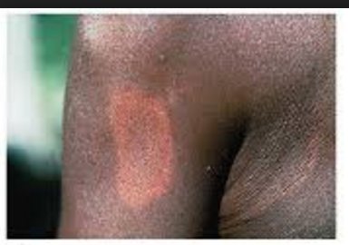 <p>nerve cells are infected, loss of sensitivity and may recover spontaneously</p>