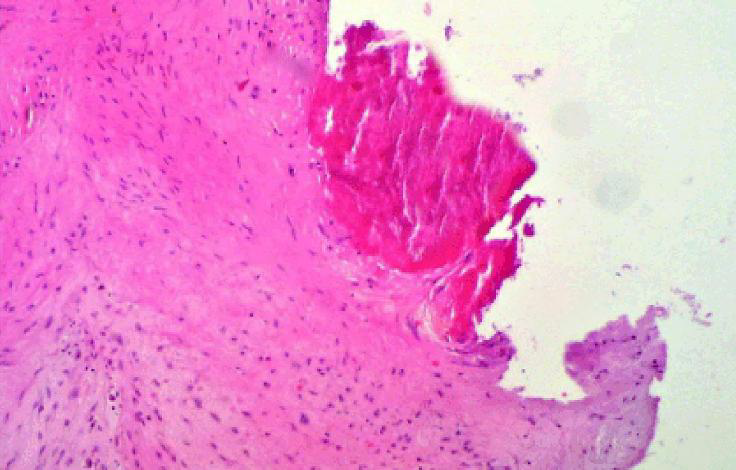 <p>mucopolysaccharidosis</p>