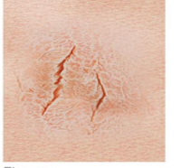 <p>linear of the superficial layer of skin, often moist and shallow</p>