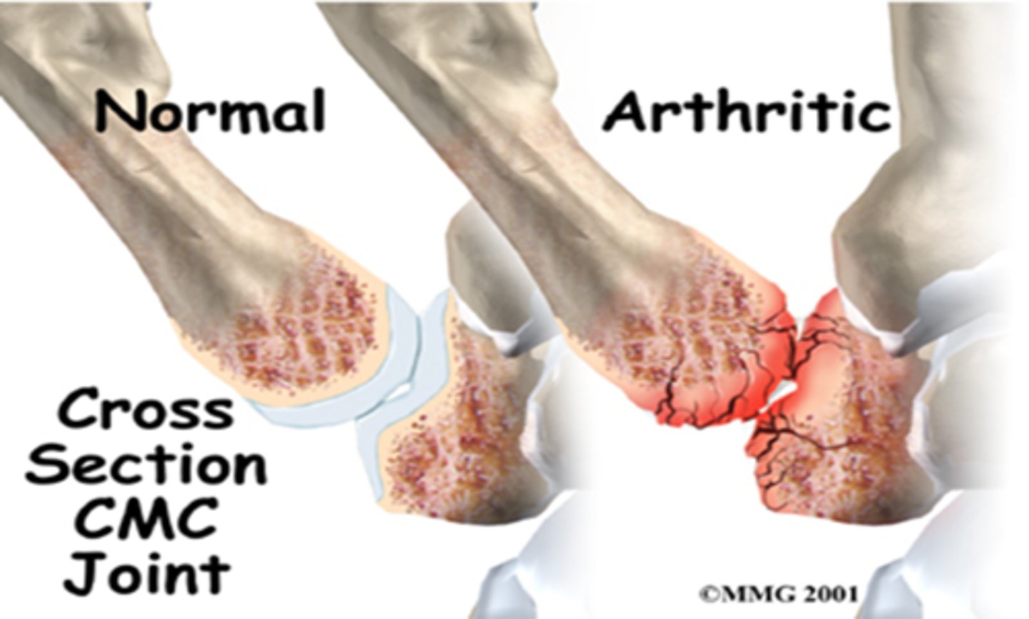 <p>Pathophysiology:</p><p>Degenerative attenuation of stabilizing ligaments followed by increased mechanical stress</p><p>of the CMC joint</p><p>- 40% and 25% of incidence in women and men over 75 years of age respectively</p><p>- Causes debilitating pain and weakness in pinching and loading activities</p>