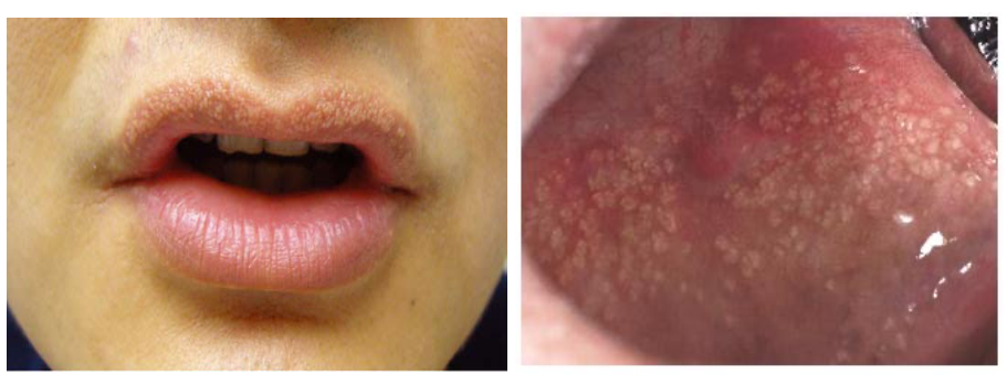 <p>Fordyce Granules → <span>mall, yellowish-white, or slightly reddish bumps in oral cavity </span></p><p>60-70% of adults have them </p><p></p>