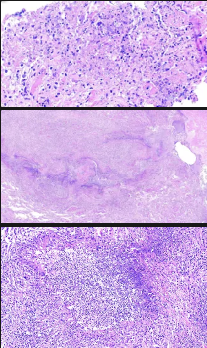 <p>La granulomatosis con poliangitis (de Wegener), tiene granulomas con patrones _____ de necrosis central&nbsp; caseosa y estos granulos mas están rodeados por una zona de _______ con células gigantes e infiltrado leucocitario</p>