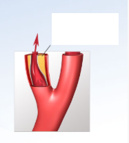 <p>If this was taken at the carotid bifurcation and there is atherosclerotic plaque seen in the internal carotid artery, how will that affect the internal carotid artery? </p>