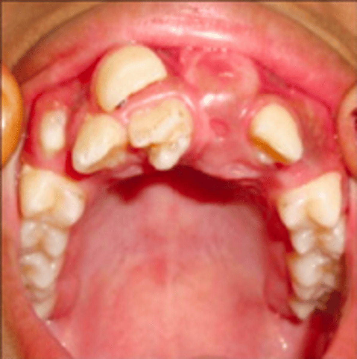 <p>Hyperdontia can be a sign and associated with what GI condition?</p>
