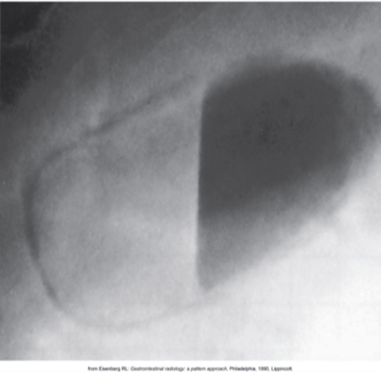 <p>What is Emphysematous Cholecystitis?</p>