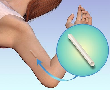 <p>verminderen van vruchtbaarheid (hormonaal)</p><ul><li><p>het hormonaal implantaat</p></li></ul><p></p>