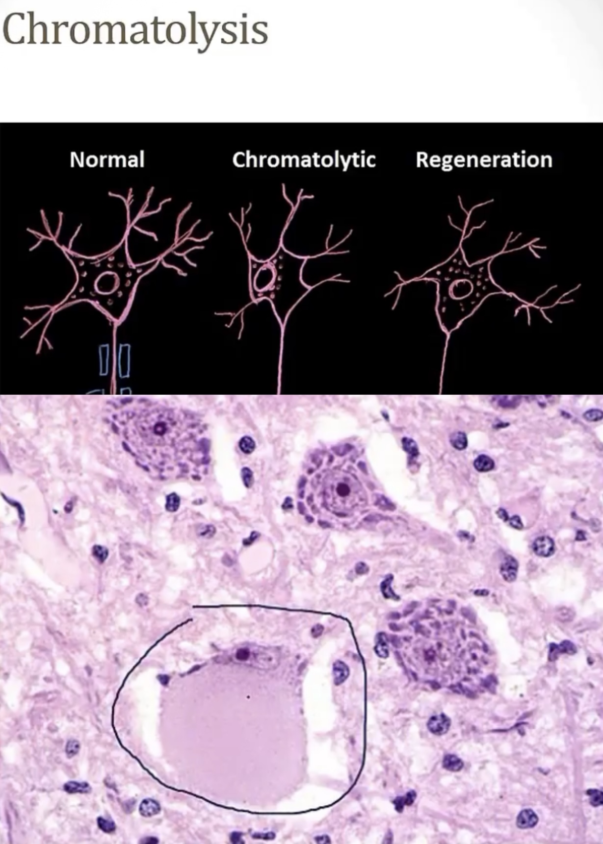 <p>-most mild is neurapraxia(focal demyelination; intact axon distant to the injury)</p><p>-moderate is axonotmesis(demyelination with axonal damage, the endoneurium and perineurium remain intact)</p><p>-severe is neuromesis(irreversible damage to axon and sheath, no regeneration occurs)</p><p>MORE ON AXONOTMESIS…</p><p>-wallerian; degenerates; involutes</p><p>-Schwann</p><p>-axonal reaction/central chromatolysis; protein synthesis; swelling; chromatolysis; periphery</p>