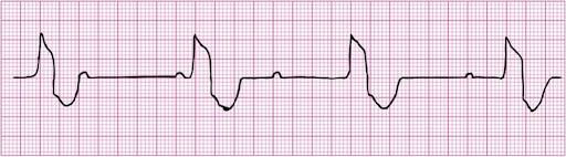Rate: atrial 60 – 100; ventricular usually 20 – 60

Regularity: regular

P waves: upright, matching, dissociated from QRSs

PR: varies

QRS: < 0.12 secs if AV junction is pacemaker; > 0.12 secs if ventricle is pacemaker
