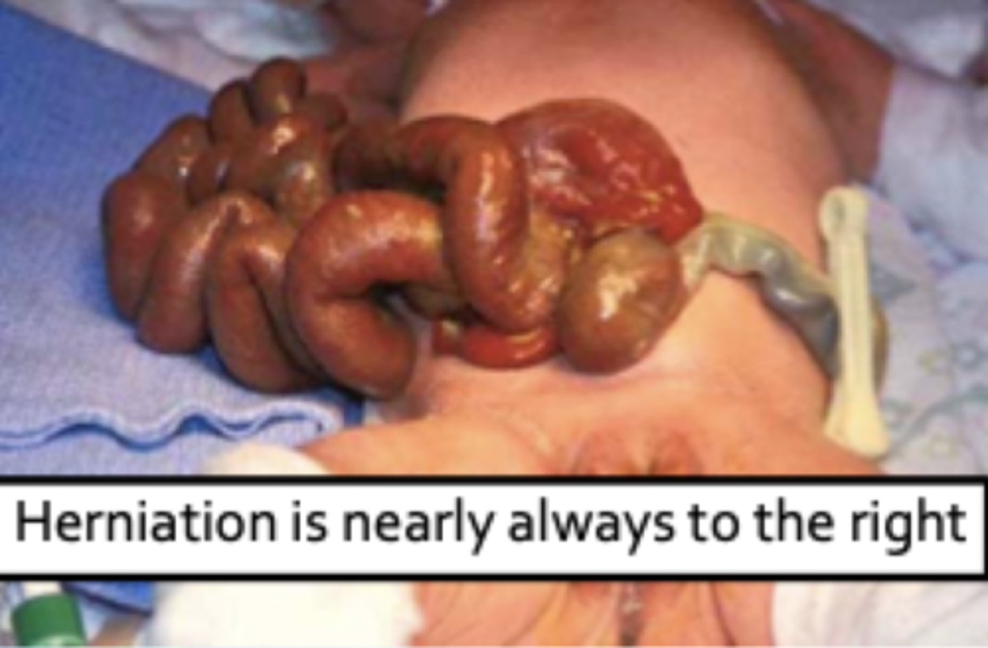 <p>congenital fissure of the abdominal wall, not at the umbilicus</p><p>- often in first born males to young mothers</p><p>- associated w/ aspirin use early in pregnancy</p><p>- may also be assoc. w/ smoking, drug use, other disruptions to blood flow</p>