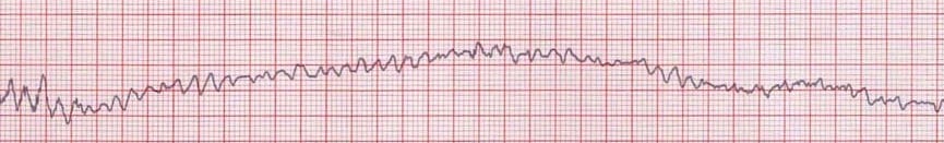 <p>id this EKG</p>