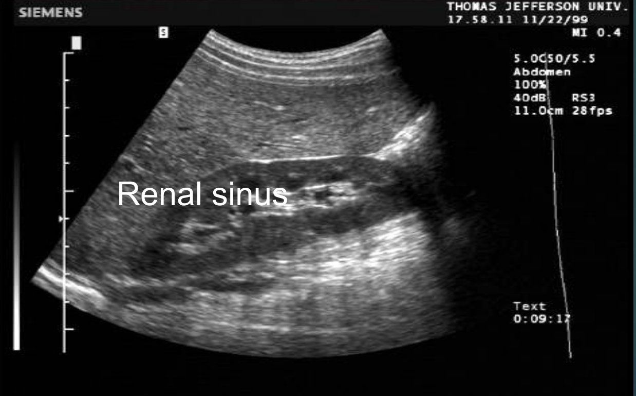 <p>Renal sinus US appearance : Intense compact zone of homogenous central echos.</p>