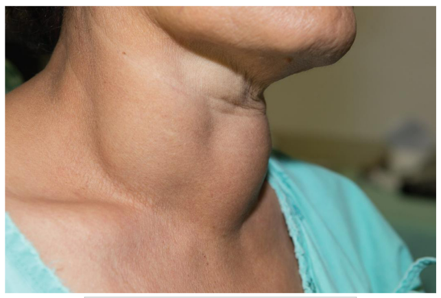 <p><span style="background-color: transparent;"><span>is the most common due to iodine deficiency</span></span></p>