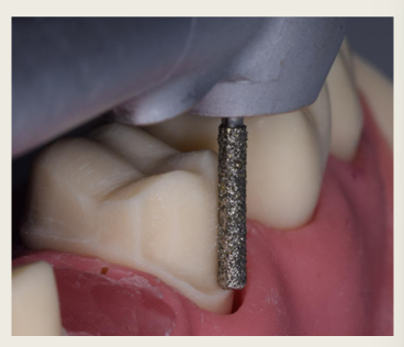 <ul><li><p>90 degrees </p></li><li><p>1.0-1.2 mm</p></li><li><p>prepared with a <strong>flat </strong>ended bur</p></li></ul><p></p>