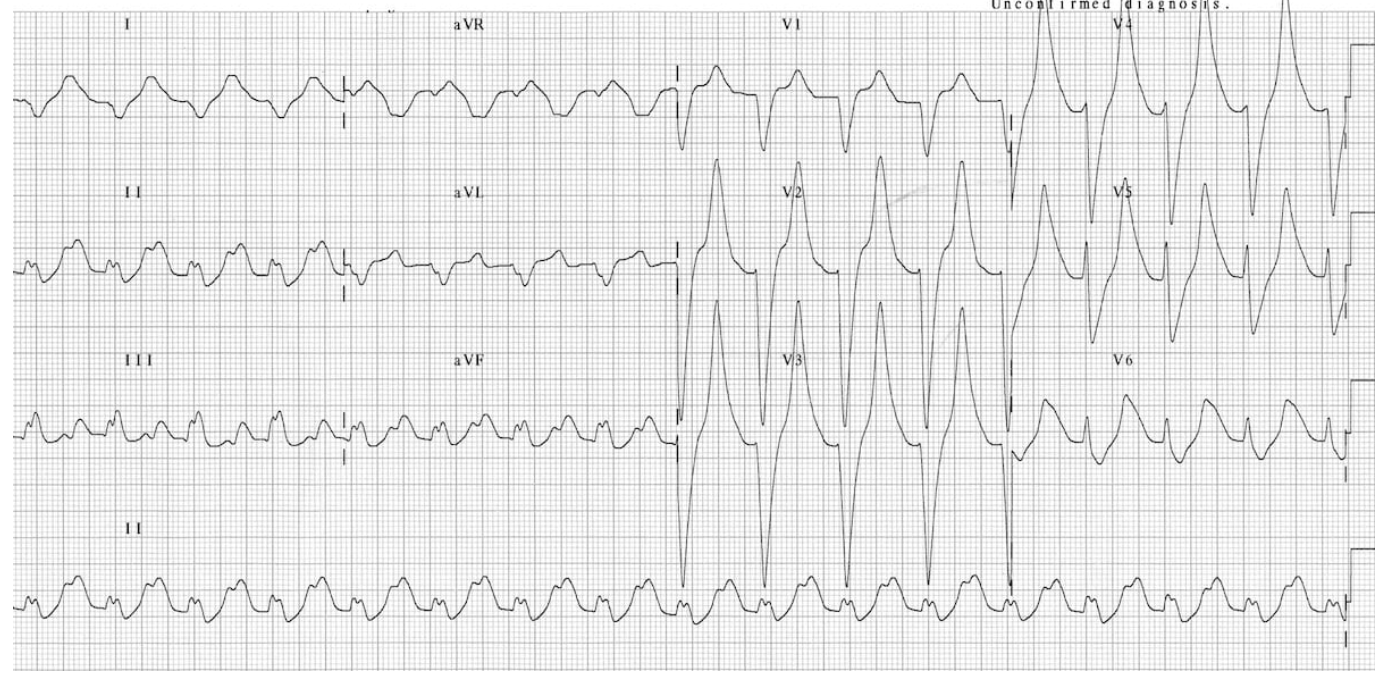 <p>EKG findings in HYPERkalemia</p>