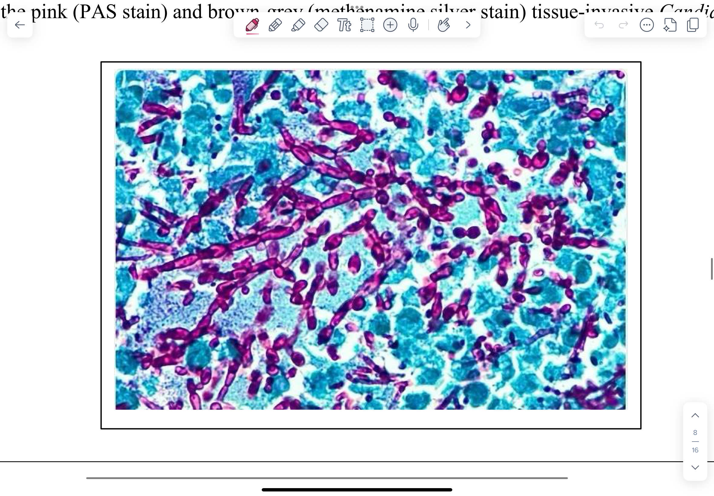 <p>Pink (PAS stain) and brown-grey (methenamine silver stain) tissue-invasive Candida hyphae.</p>