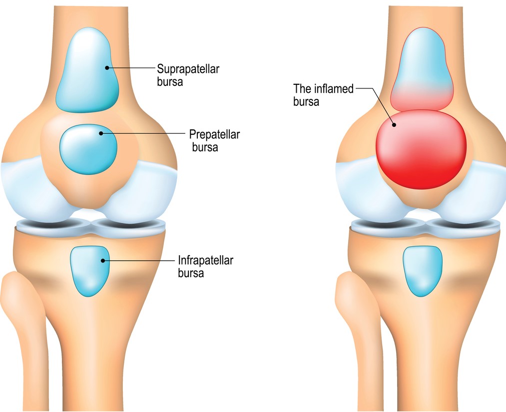 inflammation of a bursa due to injury or overuse
