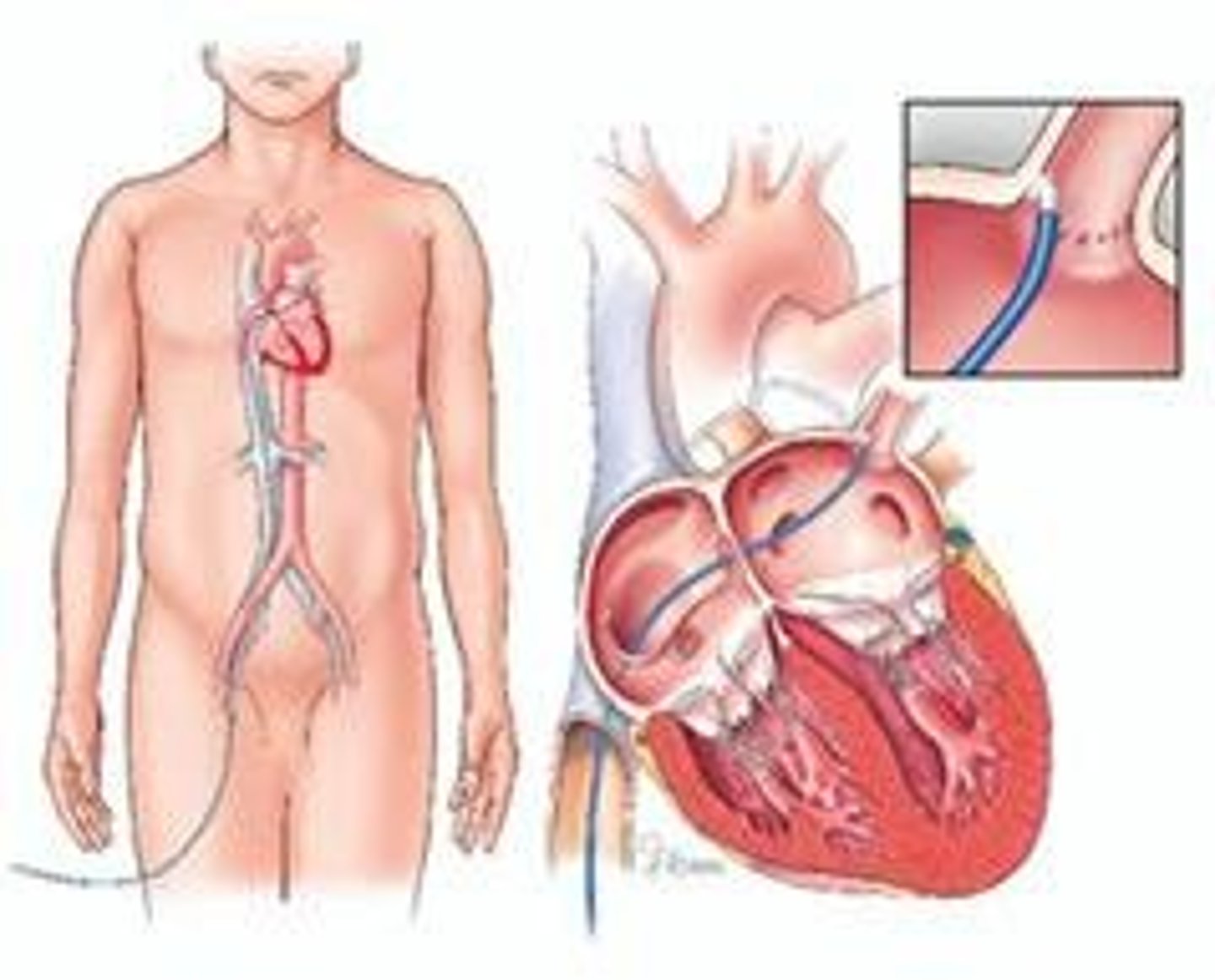 <p>Procedure to open blocked coronary arteries.</p>