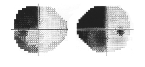 <p>describe this VF defect </p>