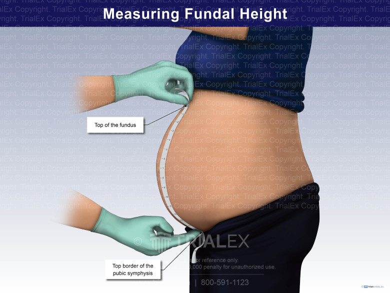 <p>Measure from the symphysis pubis to the fundus </p>