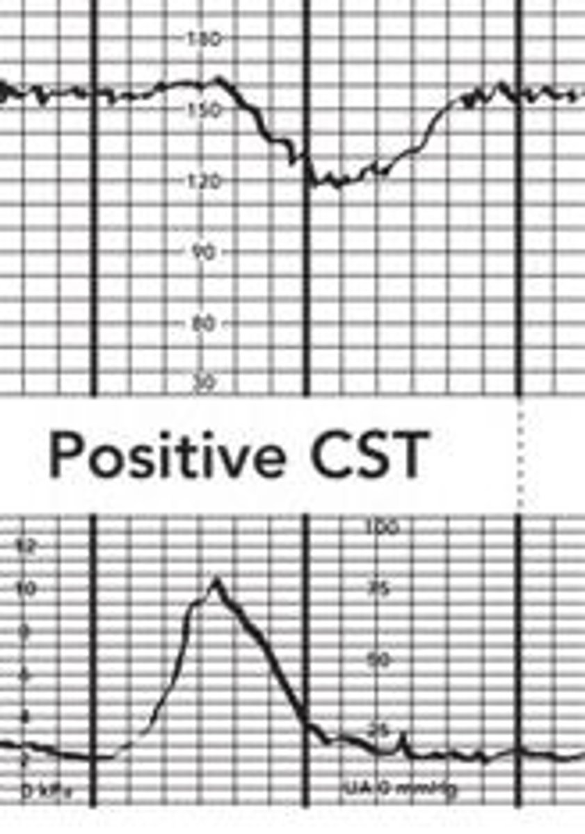<p>abnormal</p><p>The contraction stress test — also called a stress test or an oxytocin challenge test — may be done during pregnancy to measure the baby's heart rate during uterine contractions. Its purpose is to make sure the baby can get the oxygen he needs from the placenta during labor.</p>
