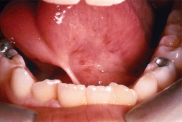 <ul><li><p>“tongue-tied”</p></li><li><p>tongue is “anchored down”</p></li><li><p>results from a short attachment of the lingual frenum that extends to the tongue apex </p></li></ul><p></p>