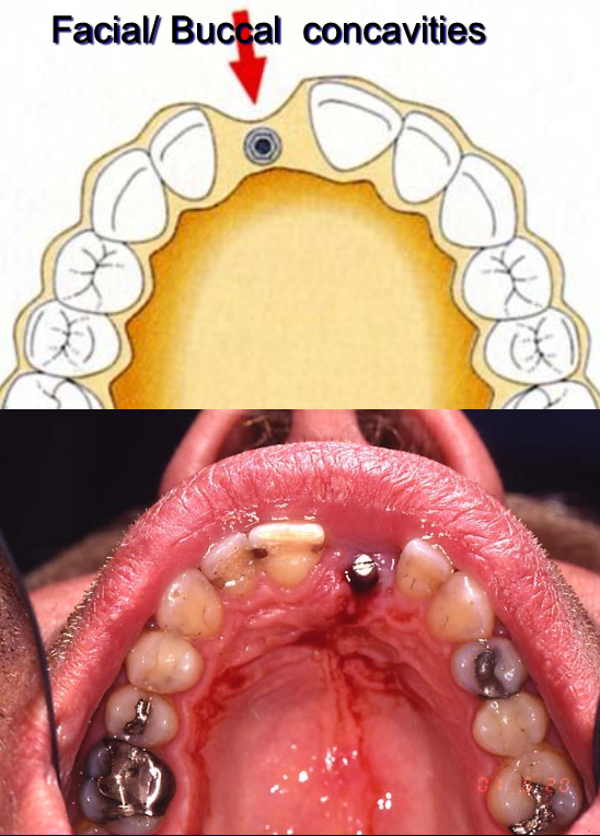 <p>What are some considerations regarding the width of ridge?</p>