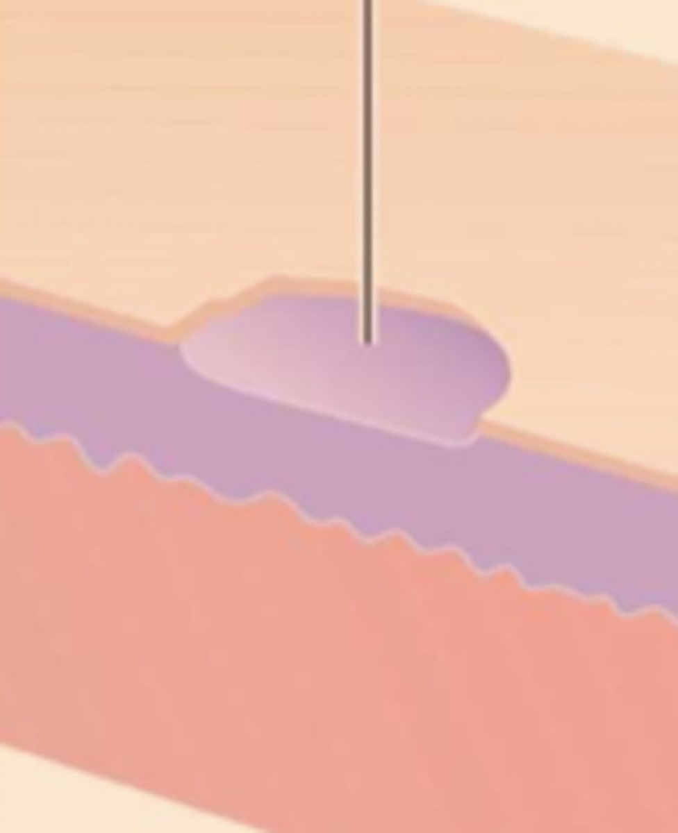 <p>¿lesión?</p><p>¿primaria o secundaria?</p>