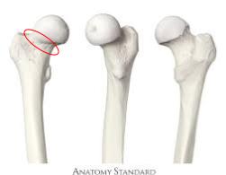 <p>the area inferior to the femur head where the bone gets thinner</p>