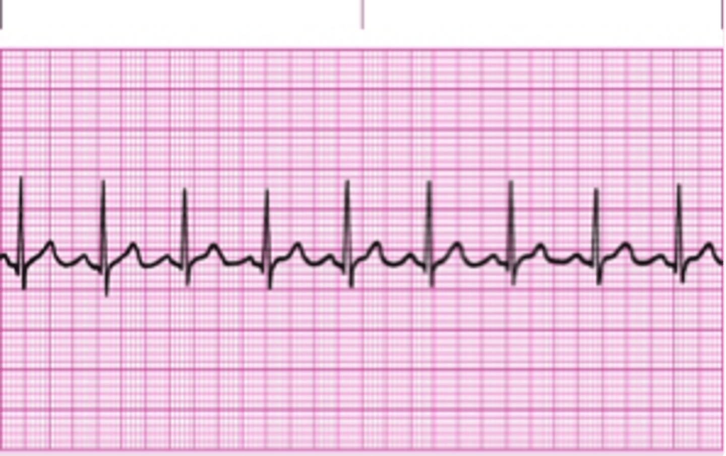 <p>regular and consistent rhythm originating in the SA node</p>