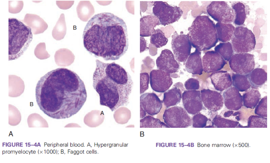<p>which FAB classification is associated with the following information?</p><ul><li><p>differentiation block at the promyelocyte stage&nbsp;</p></li><li><p>risk of DIC&nbsp;</p></li></ul><p></p>