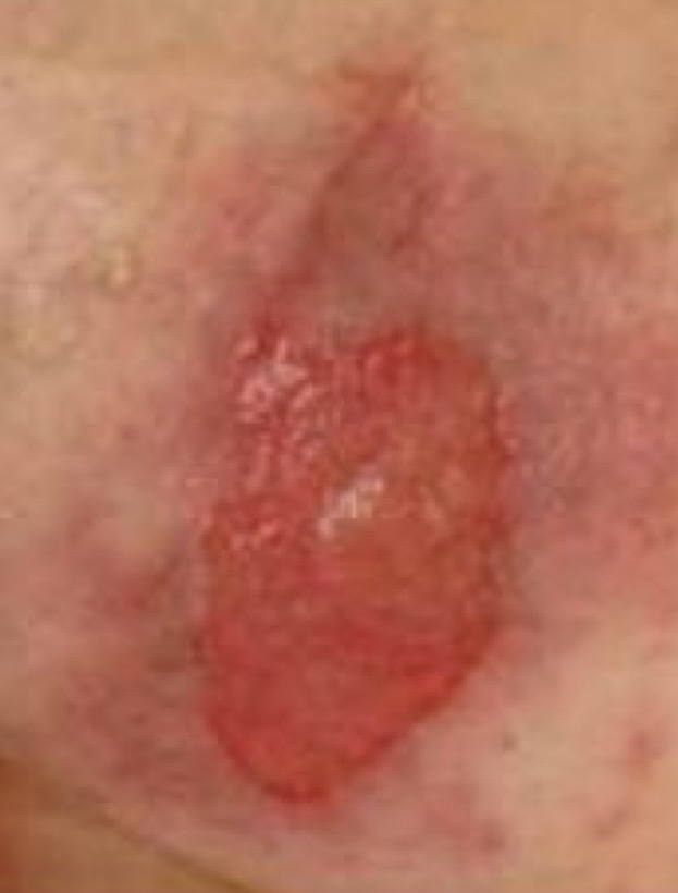 <p>Partial-thickness loss of skin</p><p>Can appear as an open ulcer or fluid-filled blister </p><p>Wound bed may appear red or pink</p>