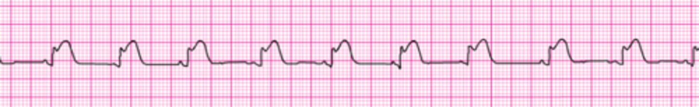 <p>A patient's 12-lead ECG was transmitted by the paramedics and showed an acute MI. The above findings are seen on rhythm strip when a monitor is placed in emergency department. The patient had resolution of moderate (5.10) chest pain with 3 doses of sublingual nitroglycerin. Blood pressure is 104/70 mm Hg. Which intervention below is most important, reducing in-hospital and 30-day mortality?</p><p>1. Reperfusion therapy.</p><p>2. IV nitroglycerin for 24 hours.</p><p>3. Temporary pacing.</p><p>4. Atropine 0.5 mg IV, total dose 2 mg as needed.</p><p>5. Atropine 1 mg IV, total dose 3 mg as needed.</p>