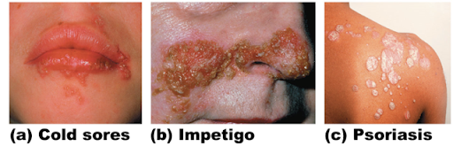 <ul><li><p>Triggered by trauma, infection, hormonal changes, or stress</p></li><li><p>Red, epidermal lesions covered with dry, silvery scales</p></li><li><p>Itch, burn, crack, bleed</p></li></ul><p></p>