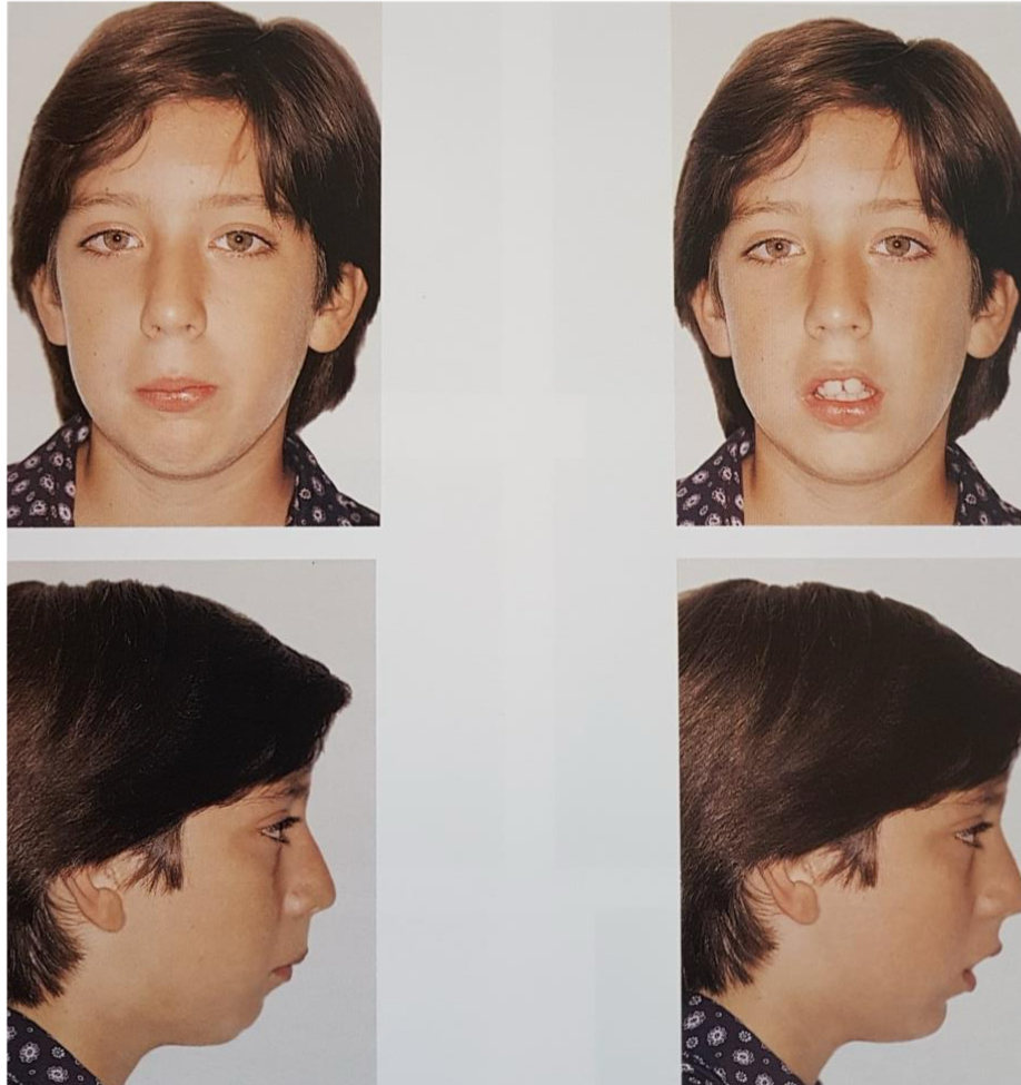 <p>Long narrow face and nose </p><p>Short upper lip</p><p>Expressionless</p>