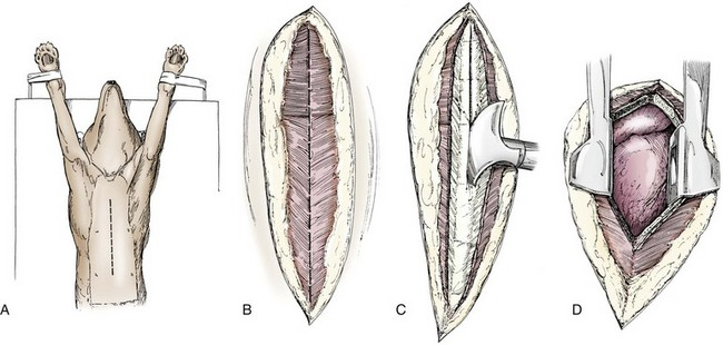 <ol><li><p>Transect sternebrae longitudinally on the midline with a sternal saw, chisel and osteotome, or bone cutters</p></li><li><p>Add drainage tube subcostal &amp; lateral to midline before closure.</p></li><li><p>Closure: depend on animal size; close with wires or heavy sutures places around sternebrae</p></li></ol><p></p>