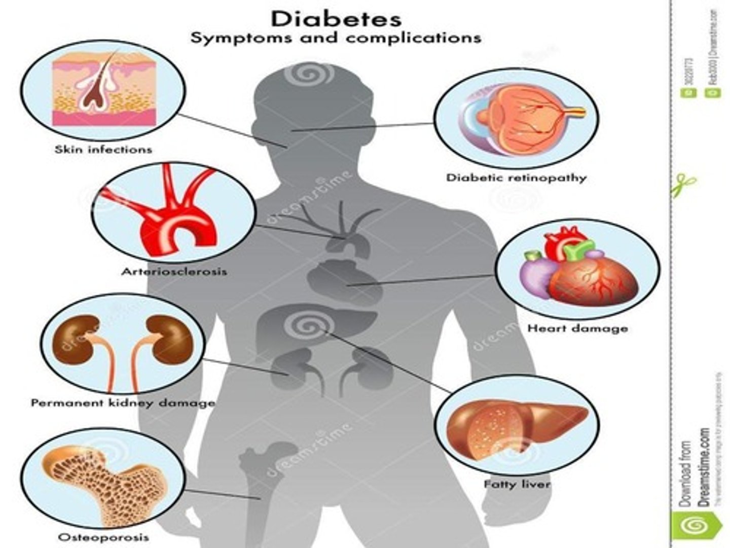 <p>retinopathy</p><p>neuropathy</p><p>nephropathy</p><p>cardiovascular disease</p><p>infections</p>