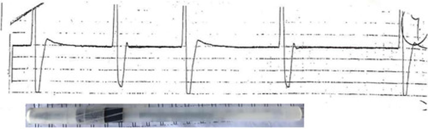 <p>What arrhythmia is this?</p>